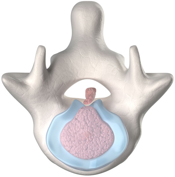 Bulging or Herniated Disc Treatment